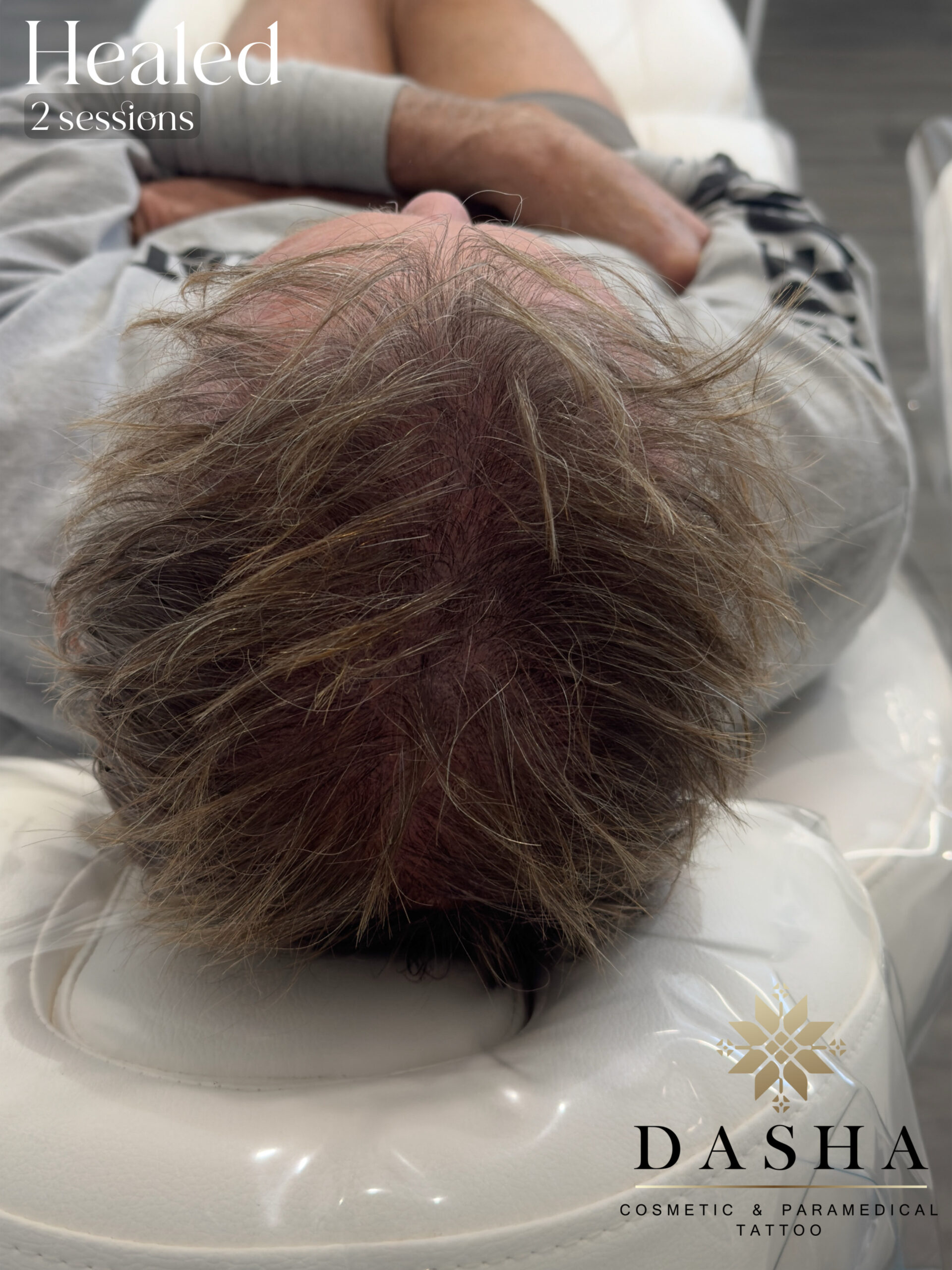Scalp Micro SMP. Cosmetic and Medical Tattoo by Dasha. Permanent makeup and reconstructive tattoo, scalp micro-pigmentation in Christchurch, New Zealand
