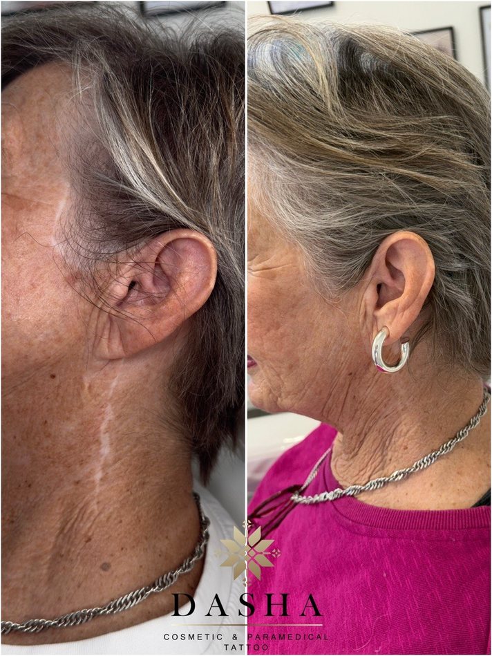 Before and after neck scar camouflage tattoo